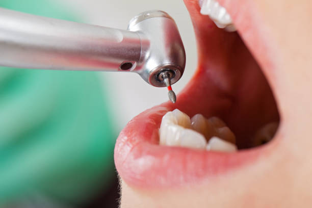 Best Lost Filling or Crown Replacement in Hampstead, MD